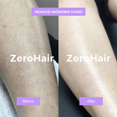 ZeroHair Cyperus Rotundus Skin Serum Natural Hair Removal Oil